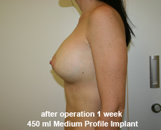 plastic-surgery-breast-augmentation